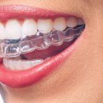 Invisalign